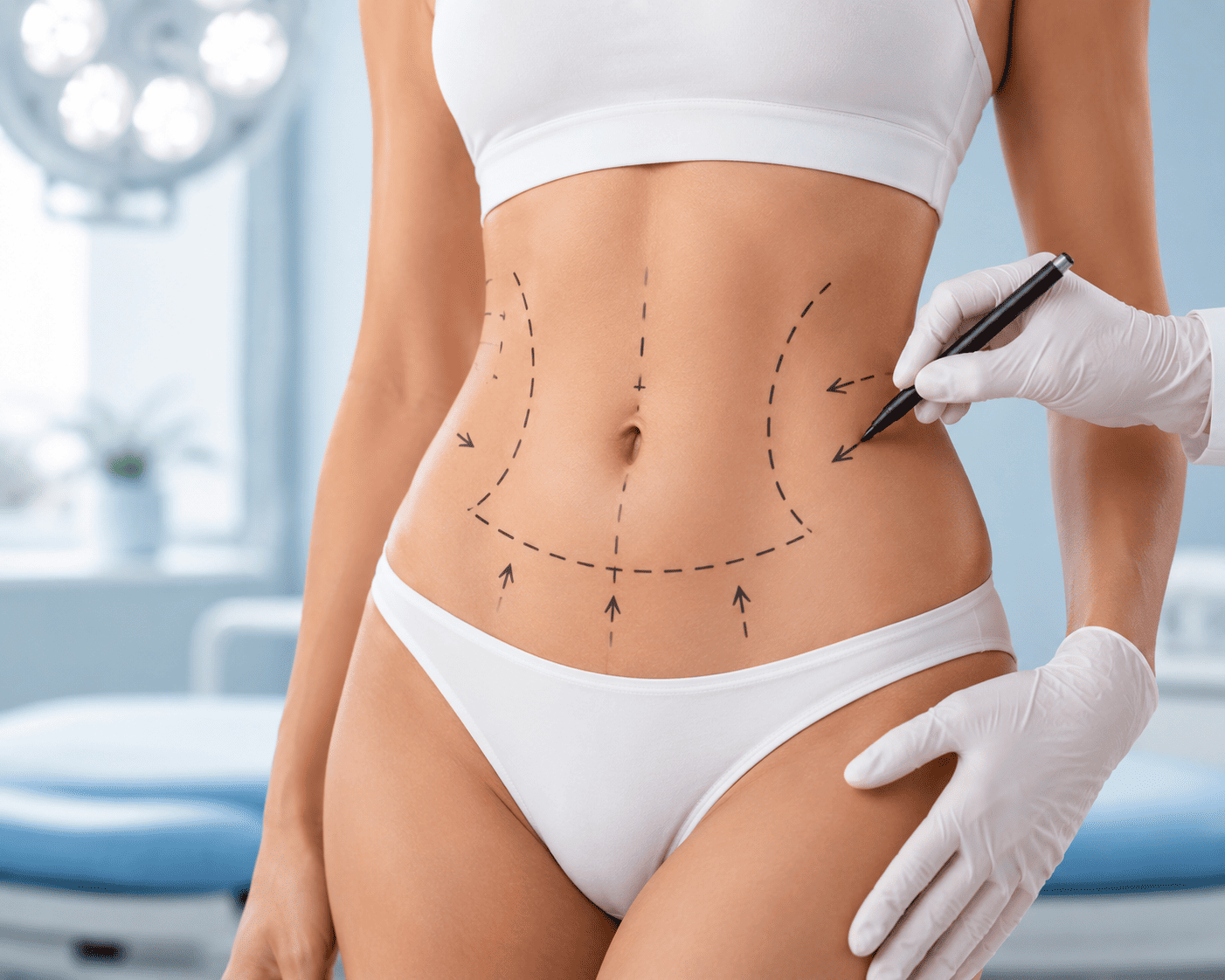 Body Contouring — surgical marking consultation